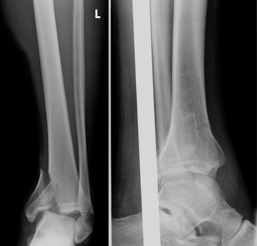 Vstupní rtg recentně po úrazu
Fig. 10: Initial X-ray shortly after injury