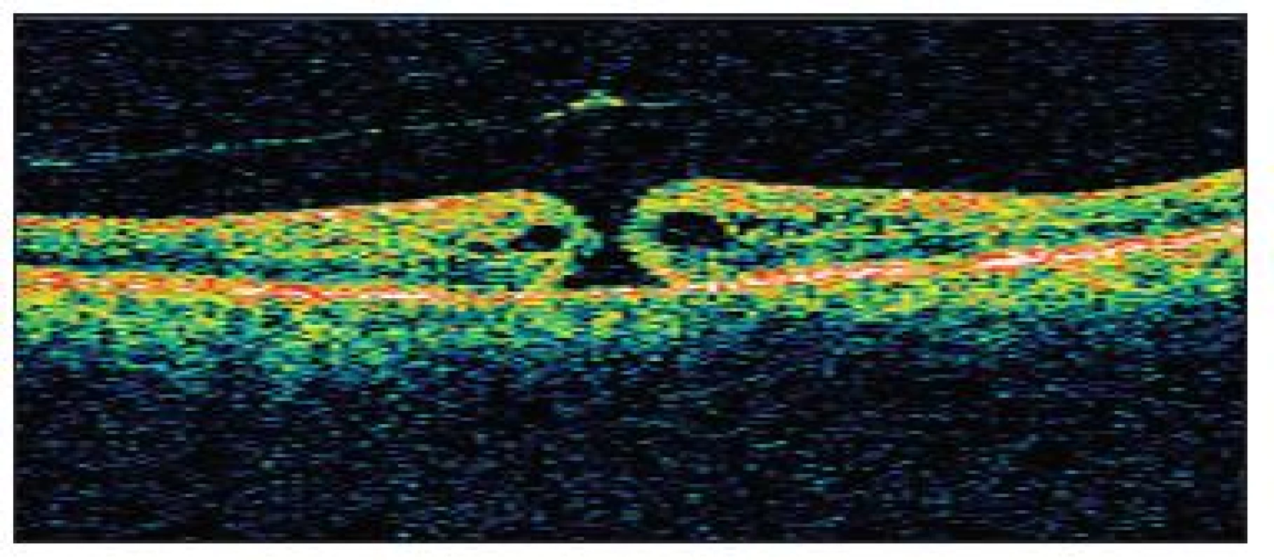 OCT obraz diery makuly II. štádia s evidentnou abláciou zadnej kôry sklovca s operculom a s cystoidným zhrubutím okrajov neurosenzorickej sietnice u pacienta č. 4