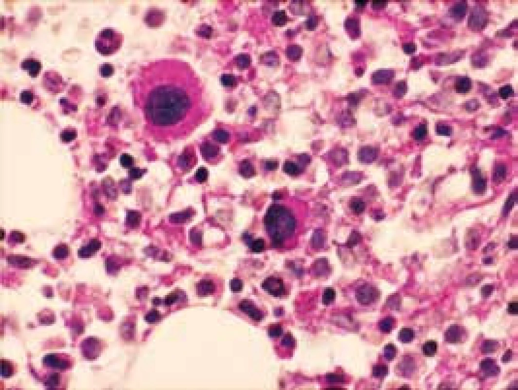 Dysplastické megakaryocyty (PAS reakcia)