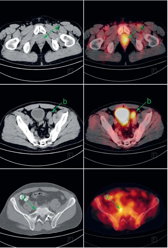 Pacient s biopticky ověřeným anaplastickým karcinomem prostaty byl v rámci iniciálního stagingu indikován k FDG-PET/CT. Patologicky zvýšená konsumpce glukózy v prostatě (a), zvětšené parailické uzlině vlevo (b) a v drobné kostní lézi sakra vpravo (c) svědčí pro generalizaci karcinomu prostaty. V močovém měchýři a ve střevech je akumulace FDG fyziologicky zvýšená. Vlevo CT v režimu nízké dávky, vpravo jeho fúze s FDG-PET.
Fig. 1. Patient with bioptically proven anaplastic prostate cancer was investigated by FDG-PET/CT as a part of initial staging. Abnormally increased glucose consumption in prostate (a), in enlarged left parailiac lymph node (b) and discrete bone lesion of the sacrum (c) represents metastatic prostate cancer. Increased FDG uptake in urinary bladder and gut is a normal variant. Left: low-dose CT; right: fusion of low-dose CT with FDG-PET.