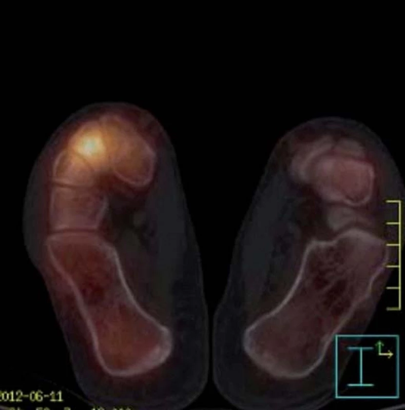 Dynamická scintigrafie (SPECT) nohou (červen roku 2012). Vyšší perfuze i metabolický obrat v oblasti Lisfrankova skloubení vpravo.