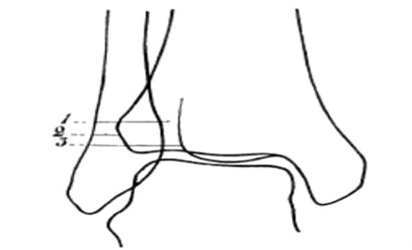 Chaputova „ligne claire“ neboli „tibiofibular clear space“ (Převzato [33]) 1 – ligne claire, 2 – tuberculum ant. tibiae (Chaputův hrbol), 3 – tuberculum post. tibiae. Linie je z mediální strany ohraničena obrysem tuberculum post. a z laterální strany mediálním okrajem fibuly.
