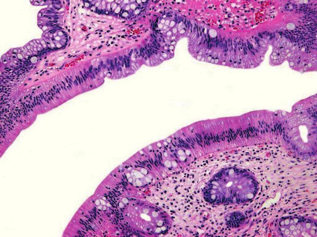 Tradiční serrated adenom. Povrchový epitel s eozinofilní cytoplazmou a s centrálně uloženými protáhlými jádry (HE, objektiv x20).