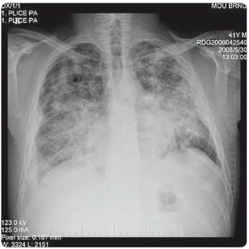 RTG snímek plic – zadopřední projekce. Snímek proveden v době progrese onemocnění po 2. sérii iniciální chemoterapie, před zahájením cílené protinádorové léčby. Na snímku je patrná rozsáhlá převážně intersticiální infiltrace obou plicních křídel - nehomogenní cárovité splývající infiltráty, nejvýraznější a nejsytější vlevo ve středním plicním poli. Fluidothorax vpravo, nově nepatrně i vlevo. Metastatické postižení skeletu.
(Vyšetření provedla: MUDr. Monika Procházková).