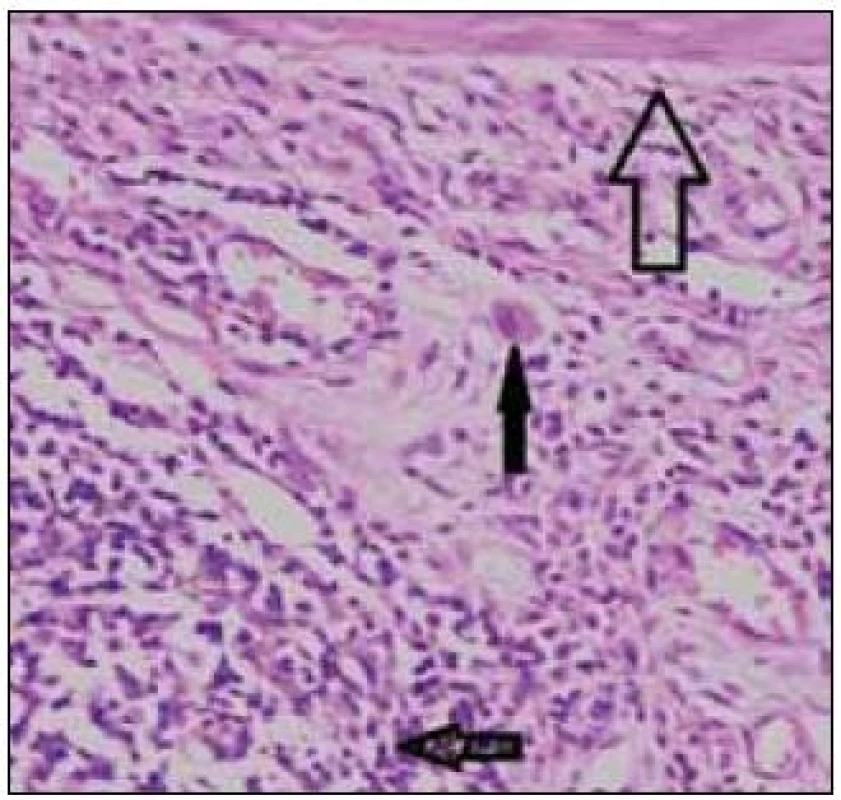 Histologické vyšetrenie. Lamina muscularis mucosae čreva v susedstve defektu (prázdna veľká šípka). Pod ňou sa nachádza zápalový infiltrát (prázdna malá šípka), v ktorom vidno aj jednu obrovskú bunku (plná šípka). Známky malignity neprítomné. Hematoxylín a eozín, zväčšenie 100-krát.