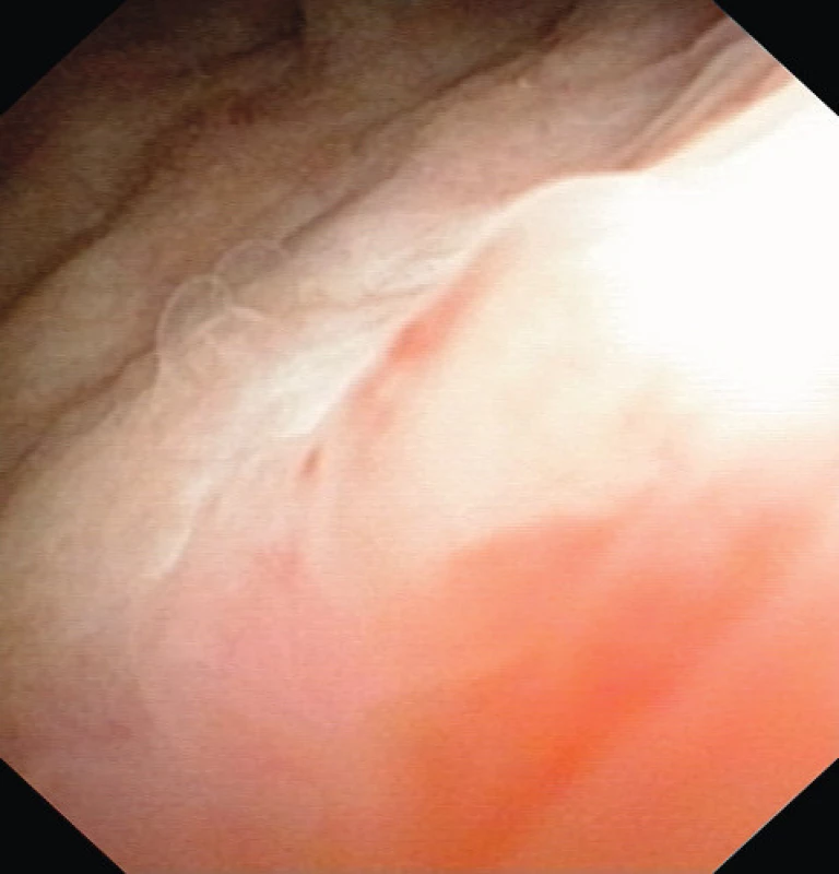 Cystoskopie čtyři měsíce po operaci
Fig. 6. Cystoscopy four months after TUR