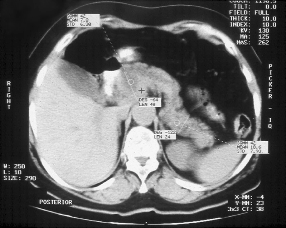 CT obraz neostře ohraničeného pankreatu se širokým pankreatickým vývodem v celém průběhu žlázy – obraz mucinózní intrapankreatické neoplazie