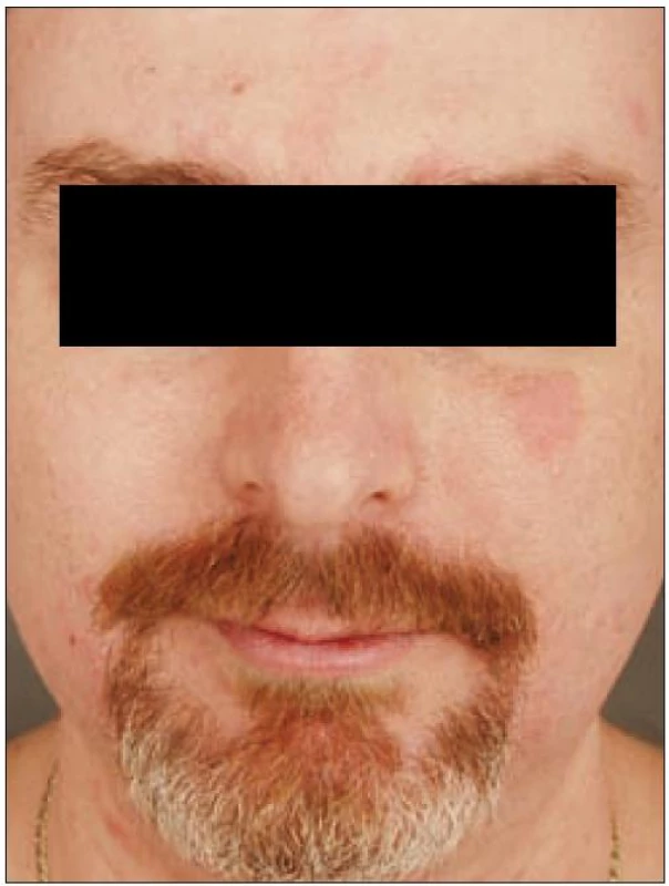 Diskrétní seborrhoiformní ložisko na levé tváři u diseminované multifokální histiocytózy.