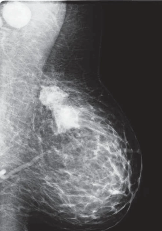 Mamogram – nádorové ložisko a zvětšené uzliny v axile