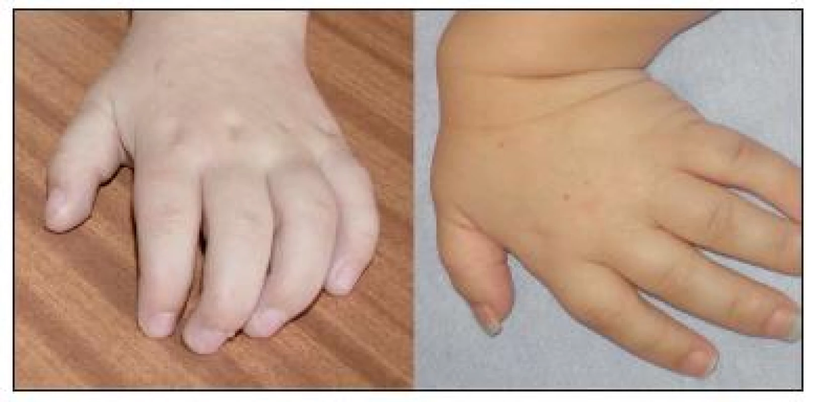 Vlevo – typická „drápovitá“ ruka u pacienta s MPS I. Vpravo – hypermobilita a hypotonie ruky u pacienta s MPS IV.
Fig. 3. On the left is the typical “clawlike hand” in a patient with MPS I. On the right there is hypermobility and hypotonia of the hand in a patient with MPS IV.