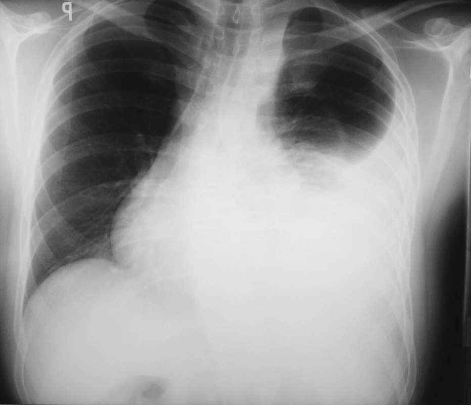 RTG hrudníku při přijetí
Fig. 1. X-ray of chest on admission