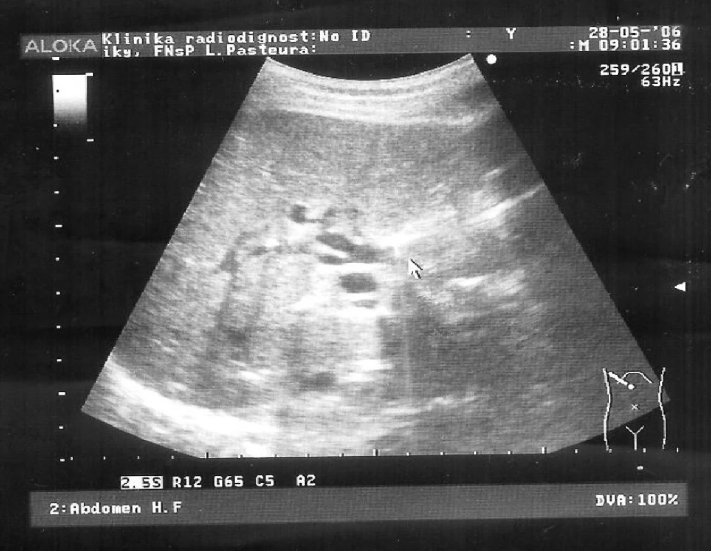 Ultrasonografia – aerobília (čierna šípka)
Pic. 5. Ultrasonography – aerobilia (black arrow)