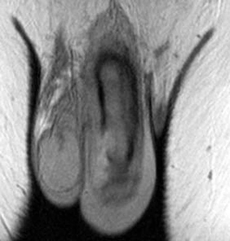 Fraktura penisu: patrná ruptura kavernózního tělesa a hematom.