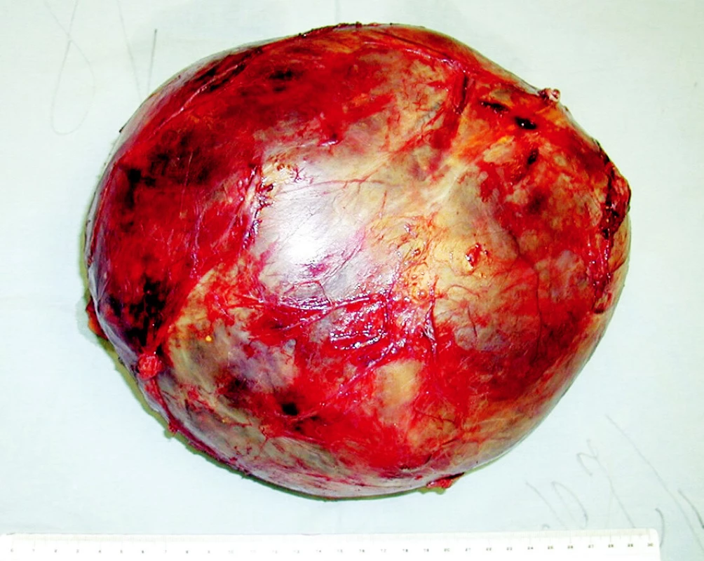 Tumor veľkosti 25x25x20 cm, ktorý bol kompletne exstirpovaný z pravého subfrenického priestoru.
Fig. 3. The tumor measuring 25x25x20 cm, which was completely removed from the right subphrenic region.