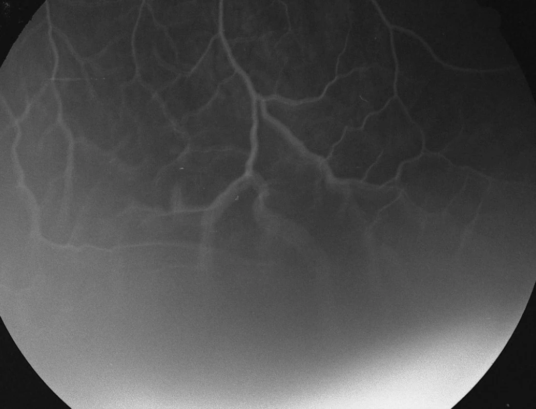 Pac. č. 5: Fluoresceínová angiografia ĽO: serózna ablácia retiny v dolnej periférii