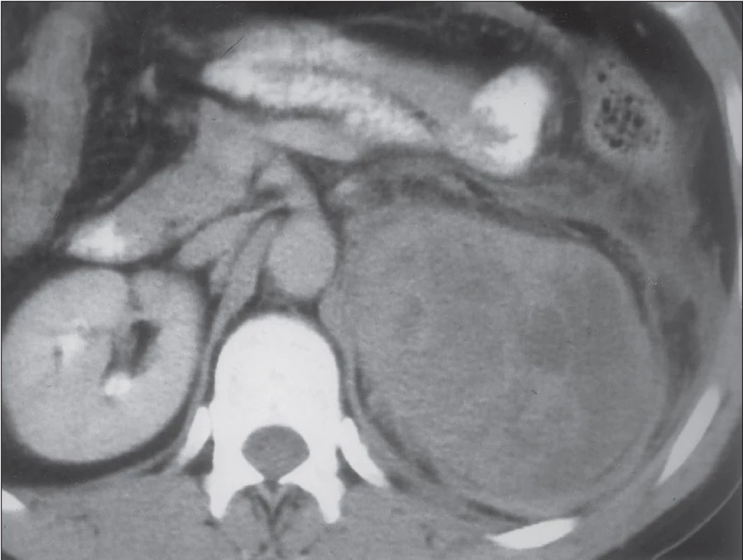 CT snímek levostranného karcinomu kůry nadledviny.
