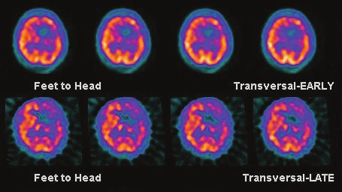 SPECT mozku (výřez tomografických řezů v transverzální rovině) - bazální a zátěžová studie (dipyridamolový test); hodnocení vizuální: horní řádek bazální vyšetření, spodní řádek po vazodilataci dipyridamolem. Významně snížená CVR fronto-temporo-parietálně vlevo u 60letého pacienta po iCMP s pravostrannou hemiparézou a dysartrií (vpravo).