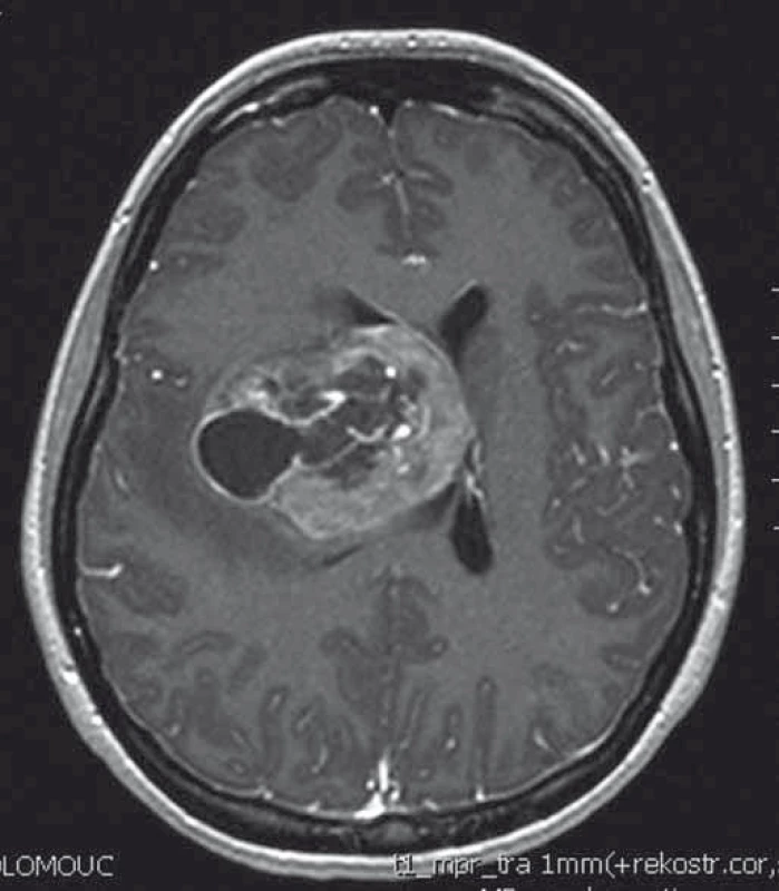 T1 vážený MRI obraz intraventrikulárního gliosarkomu.
