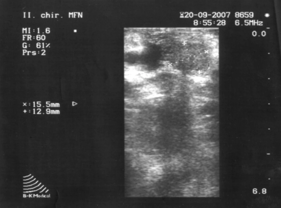 Peroperačná ultrasonografia (lokalizácia vyznačená šípkami).
Fig. 2. Per operation ultrasonography (localization demarked with arrows).
