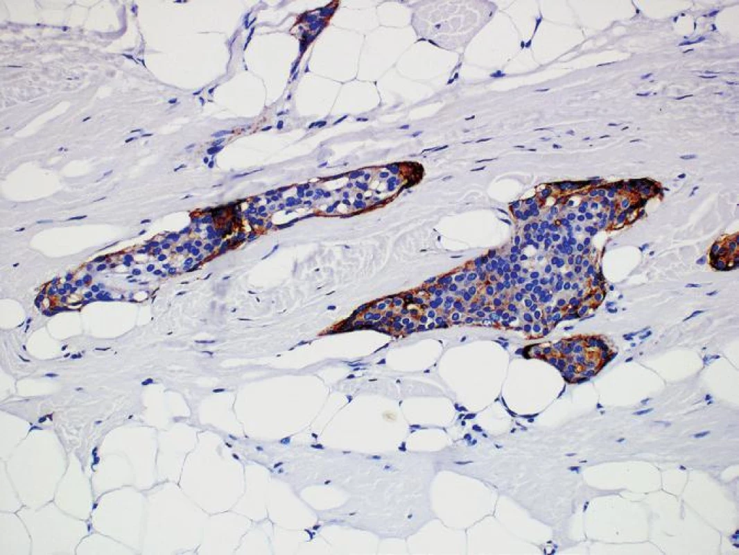 Imunohistochemický průkaz EMA (epiteliální membránový antigen) v meningoteliálních buňkách