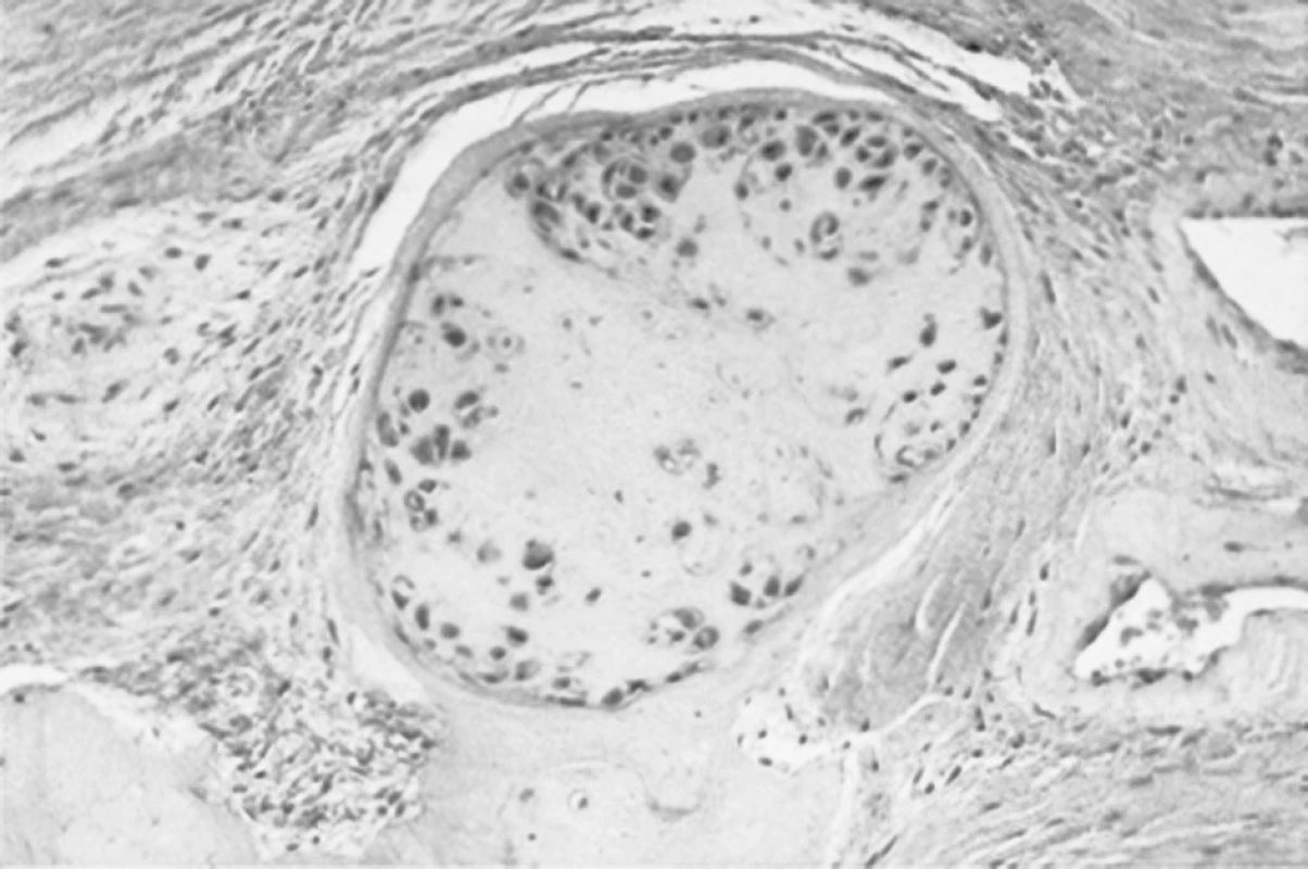 Histologie synoviální membrány: Zcela ojediněle nález připomíná změny typické pro primární synoviální chondromatózu. V synoviální membráně jsou ojedinělá ostře ohraničena ložiska ostrůvků chrupavky.
