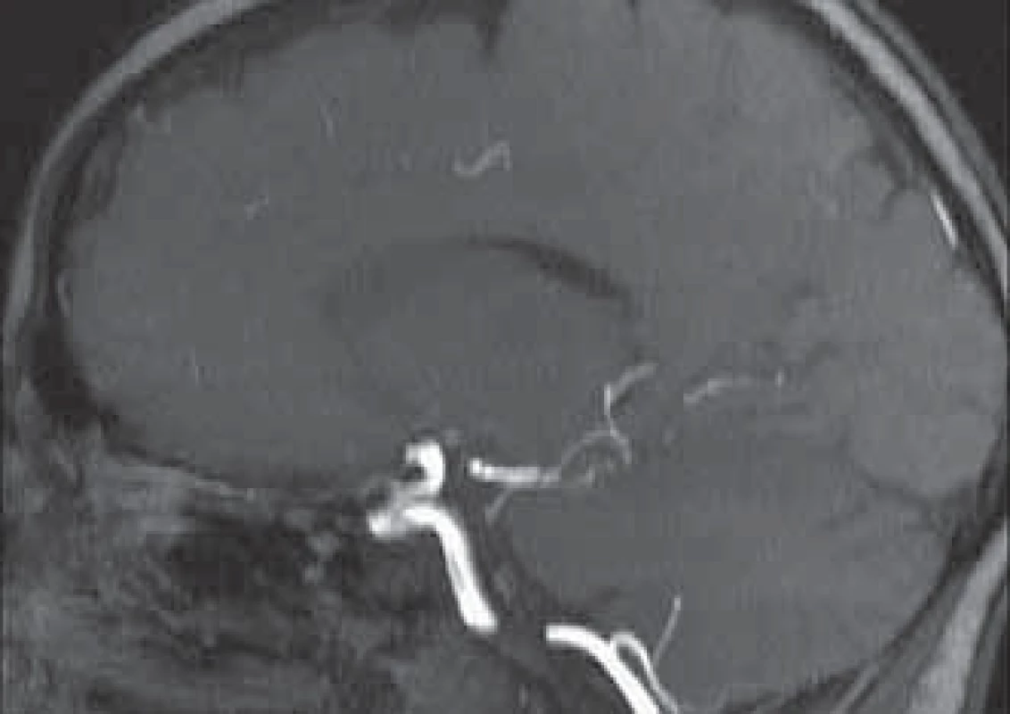 Multiplicitné segmentárne stenózy na v priebehu a. cerebri posterior l.dx. na MRI-angiograme.