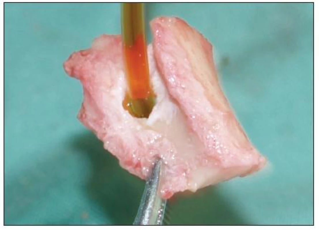 Kazuistika 1: vytnutý kostní segment při chirurgické revizi cestou laterální orbitomie sec. Kronlein se zavedeným drenem.