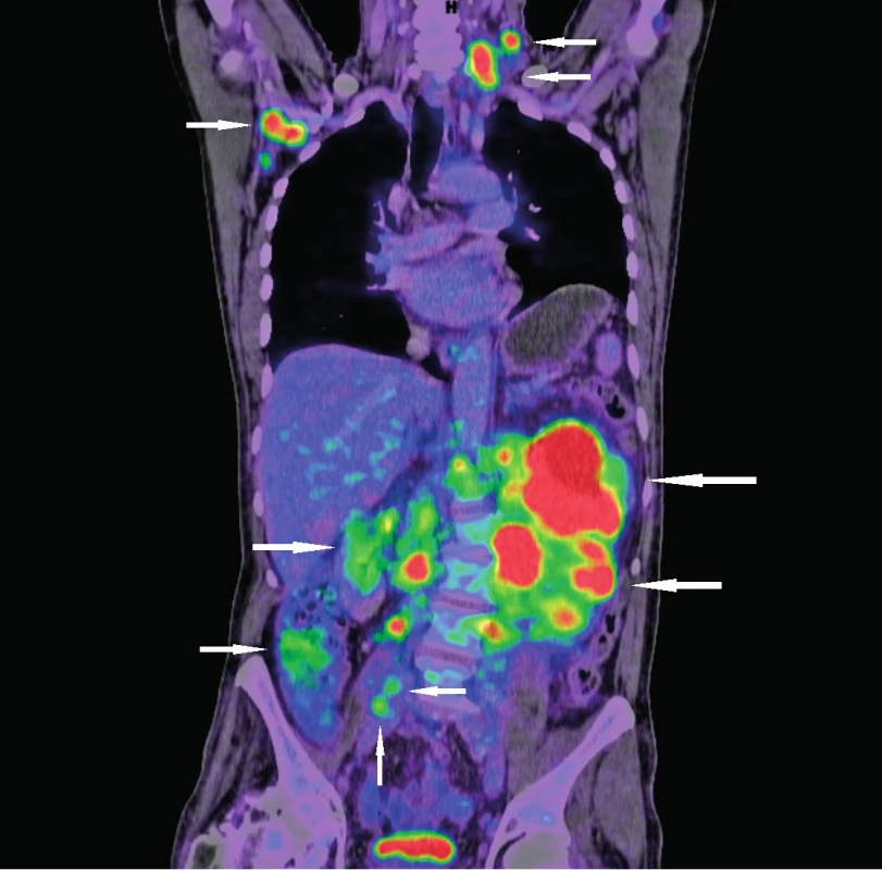 Vyšetření 18F-FDG PET/CT k zhodnocení rozsahu nádorového postižení (nádorová infiltrace označena šipkami) 
Vstupní snímky pacienta s novou diagnózou lymfomu z buněk pláště původně došetřovaného pro dyspepsie a hmotnostní úbytek