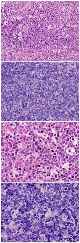Photomicrographs of a histological section showing a population of B-cell lymphoma of the Burkitt type arising in the pituitary gland – neoplastic lymphoid cells with pale macrophages forming the typical “starry sky” pattern (immunohistochemical stains not shown)
A) H &amp; E stain, original magnification x 20, B) H &amp; E stain, original magnification x 40,
C) Giemsa stain, original magnification x 20, D) Giemsa stain, original magnification x 40