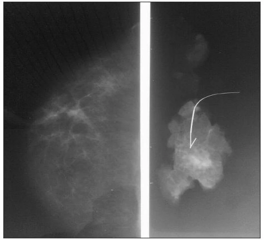 Rádiohistogram pri nehmatnej lézii so zavedeným vodičom
Fig. 6. Radiohistogram in a nonpalpable lesion with a guide introduced into the tissue