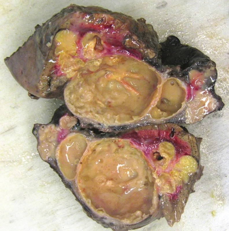 The resected tissue consisting of adjacent sections of the lungs, diaphragm and liver appears quite confusing given the network of cavities filled with a somewhat thick opaque fluid.