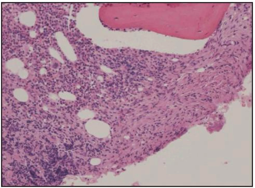Histologické hodnocení válečku kostní dřeně získaného trepanobiopsií. Barvení hematoxylin-eozin, zvětšení 100krát. Normální kostní dřeň je částečně nahrazena pěnitými a vřetenitými histiocyty (vpravo).