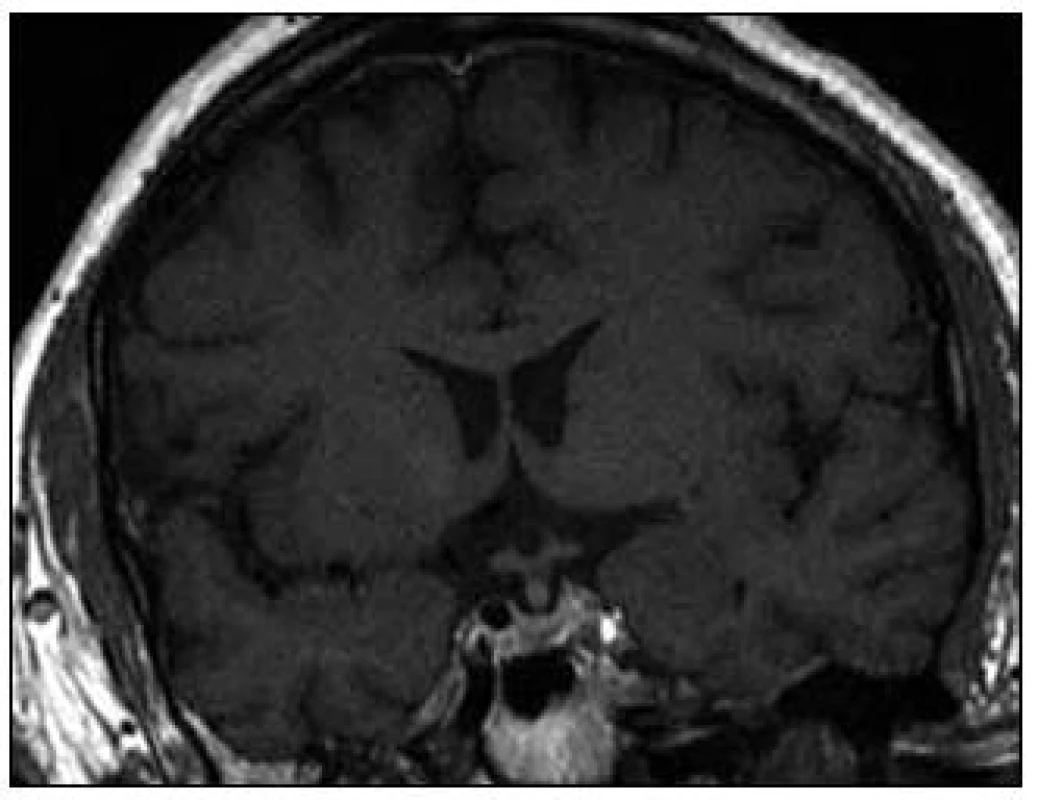 Koronární rovina MR zobrazení mozku po léčbě, T1 vážený MR obraz po aplikaci k.l. Původní výrazná
infiltrace stop
