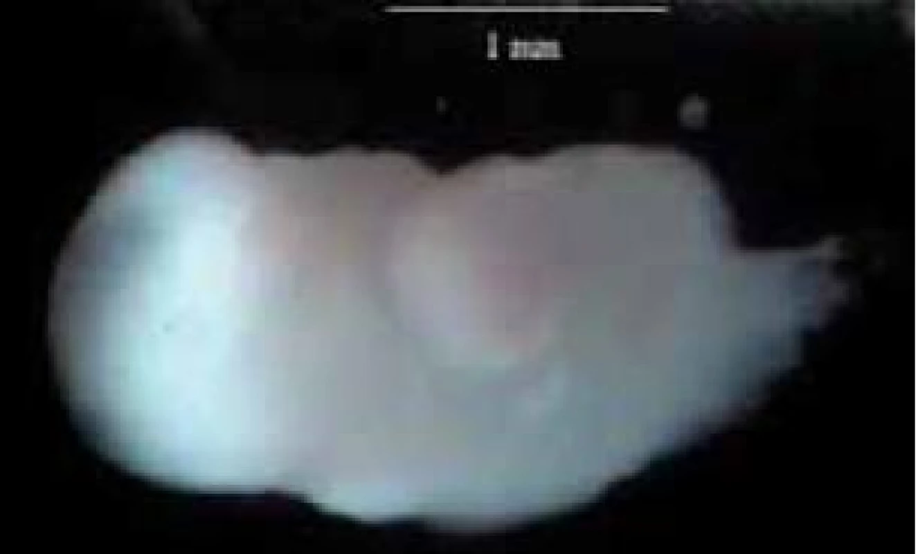 Rudimentárne, dezorganizované embryo veľkosti 2 mm.