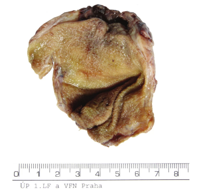 Preparát – fotografie celého žlučníku
Fig. 3. Preparation – a photo of the whole gall bladder