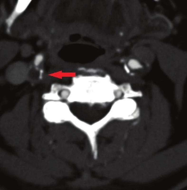 Volně vlající trombus a odstupová stenoza vnitřní karotidy
Fig. 1: Free-floating thrombus and bifurcation stenosis of the internal carotid artery