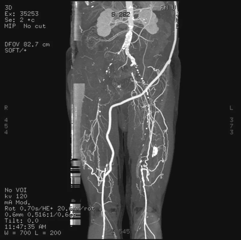 CT angiografie zobrazující uzávěr distální části axillobipopliteálního bypassu vlevo
Fig. 5. CT angiography showing the occlusion of the left distal part of the axillobipopliteal bypass