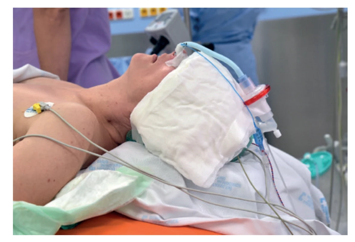 Poloha pacientky na operačním stole<br>
Fig. 1: Position of the patient on the operating table