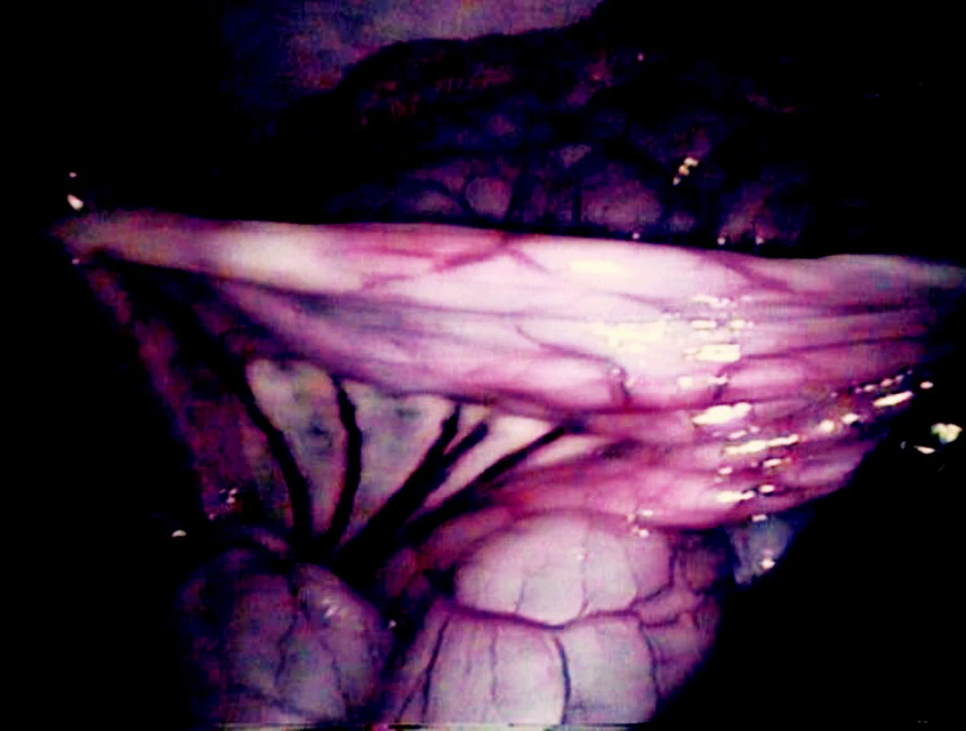 Hranice ischemie střeva v bílém světle při prosté laparoskopii
Fig. 6. The border of intestinal ischemia during laparoscopy in white light