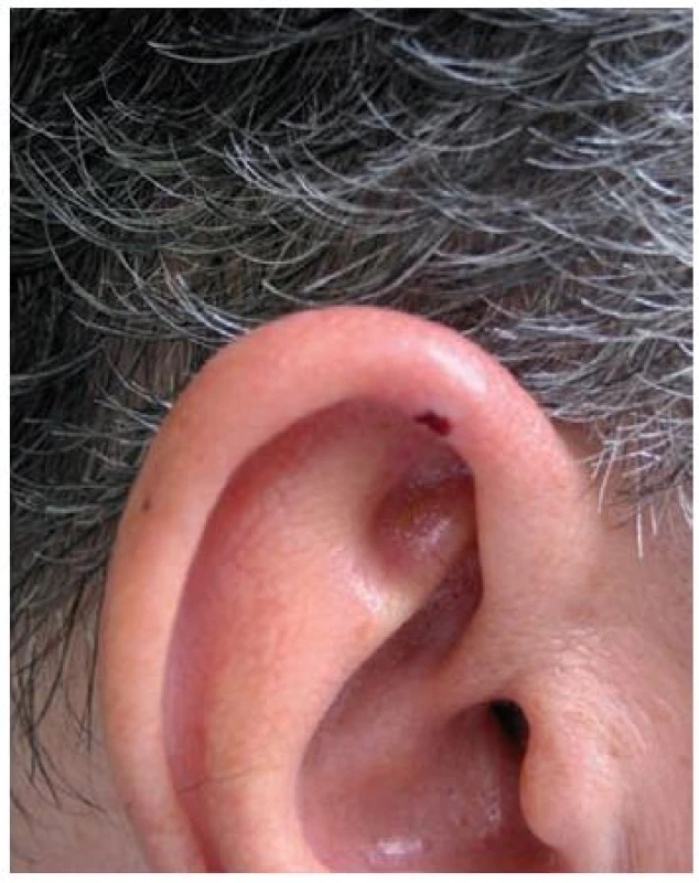 Klinický nález na pravém uchu v září 2009
