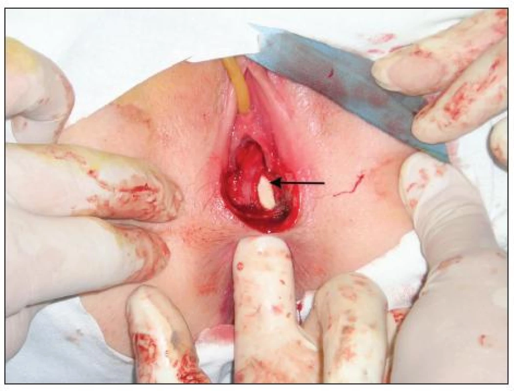 Stav po incízii perinea, prst je zavedený do rekta; perforácia rekta a vagíny je jasná (šípka)
Fig. 1. Situation after incision of the perineum, a finger is introduced into the rectum; perforation of the rectum and vagina is apparent (arrow)
