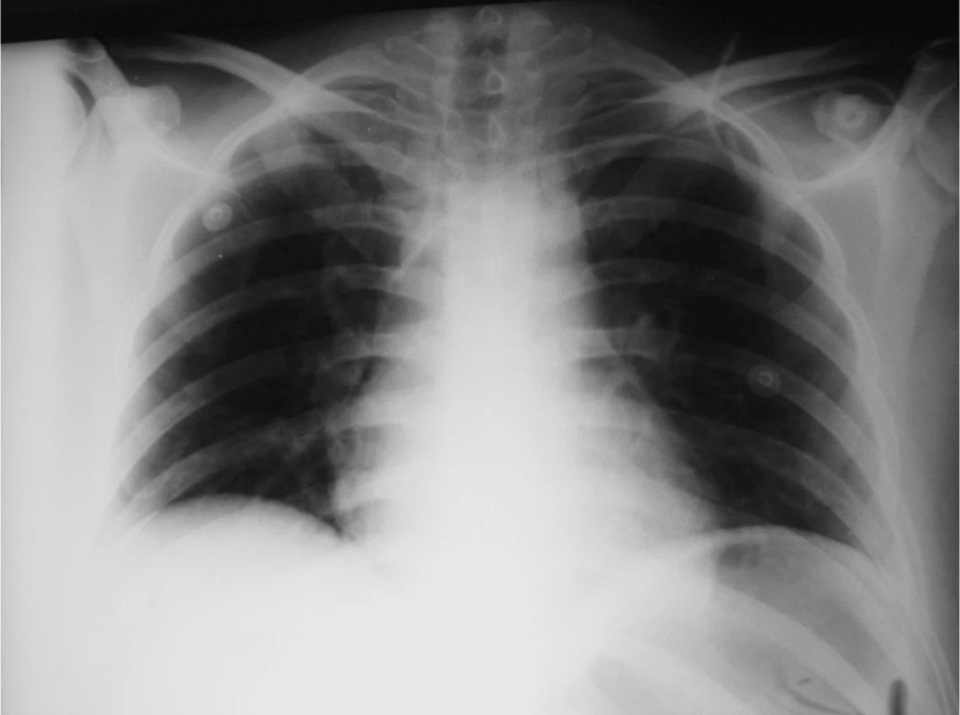 RTG plic – poloha CŽK po zavedení
Fig. 1. Pulmonary x-ray – the venous line localization following its introduction