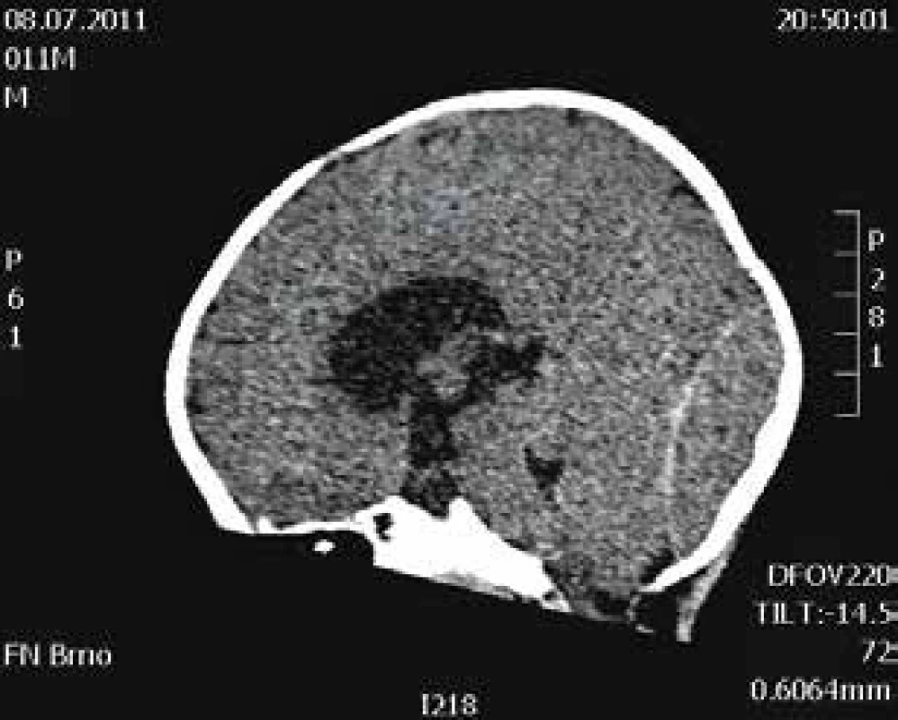 CT scan mozku, v sagitální rovině. Okcipitálně je patrný rozsáhlý hematom. Dále je zřejmá dilatace komorového systému a redukce zevních likvorových prostor.
Fig. 2. CT scan of the brain shows large lenticular hematoma of occipital region, with dilatation of ventricular system and reduction of external liquor spaces. Sagittal scan.