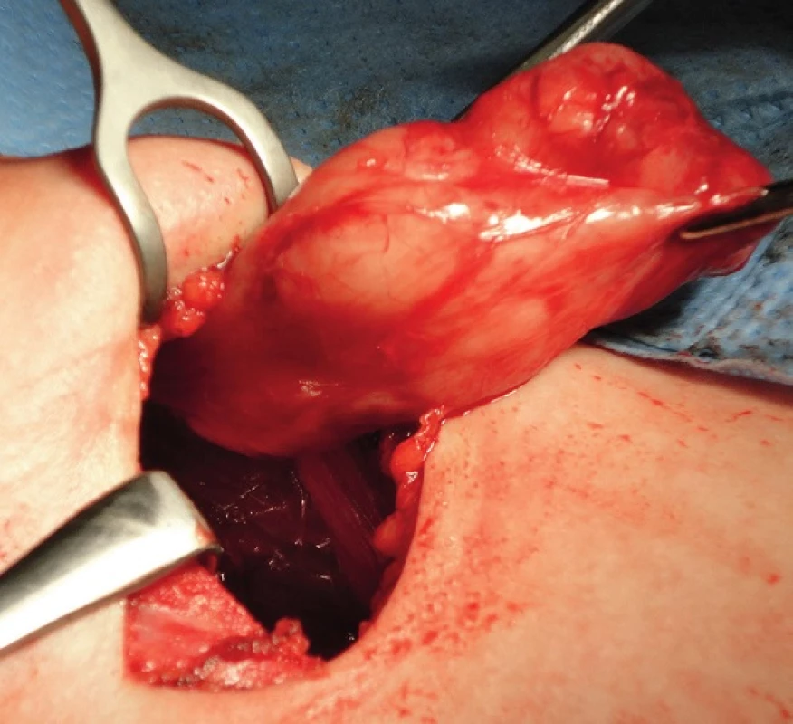 Chirurgické odstranění tumoru z límcového řezu.