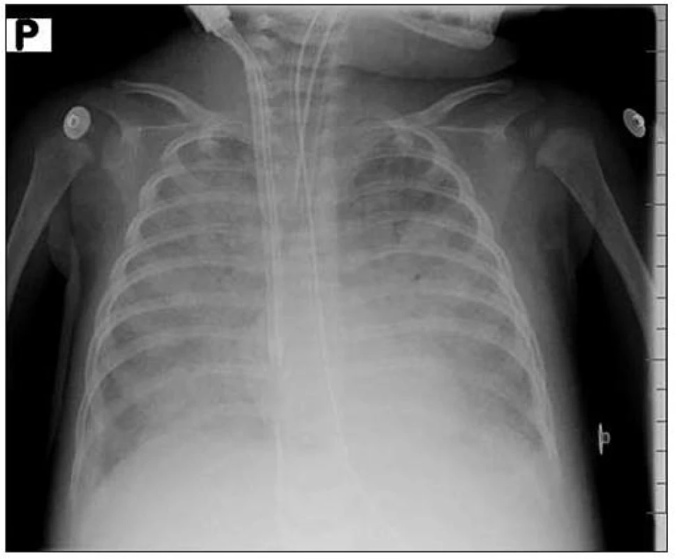 RTG nález 2. den u pacientky č. 3.
Fig. 1. X-ray finding 2nd day in female patient No. 3.