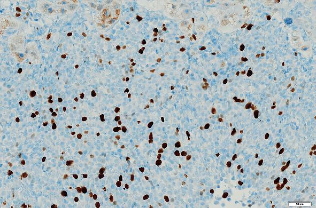 V periferních oblastech nádoru asi 20 % buněk exprimovalo proliferační marker Ki-67. Immunohistologie, měřítko 50 μm.
