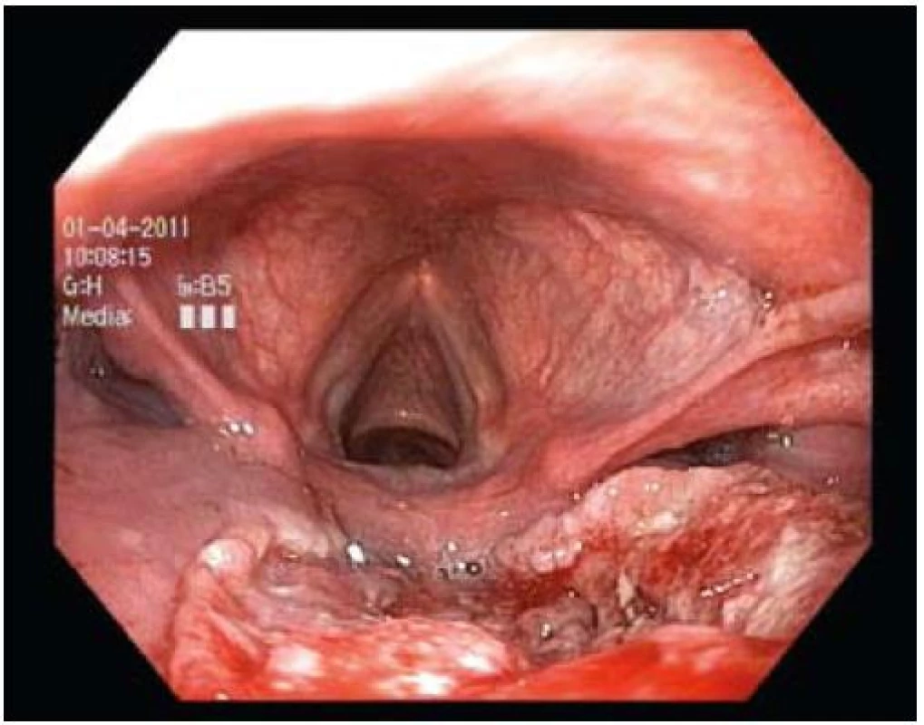 Karcinom zadní stěny hypofaryngu.
Fig. 4. Carcinoma of the posterior wall of the hypopharynx.
