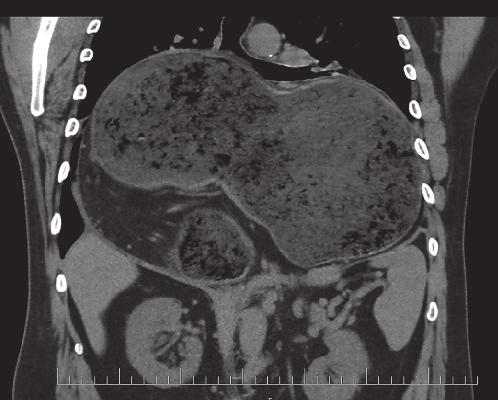 Vstupní CT (koronární řez), hiátová hernie
Fig. 1. Initial CT (coronal cross-section), hiatal hernia