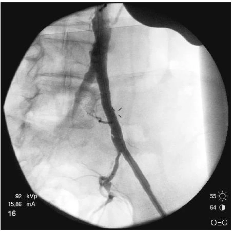 Snímek peroperační angiografie po implantaci stentu
Fig. 3. Intraoperative angiographic view following stentgraft implantation