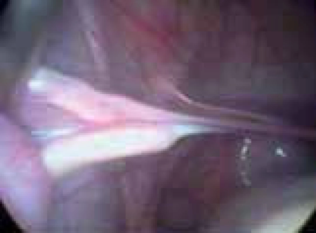 Lištovité ovarium u ženy s Turnerovým syndromem.
